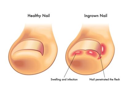 Common Causes of Nail Pain After a Pedicure