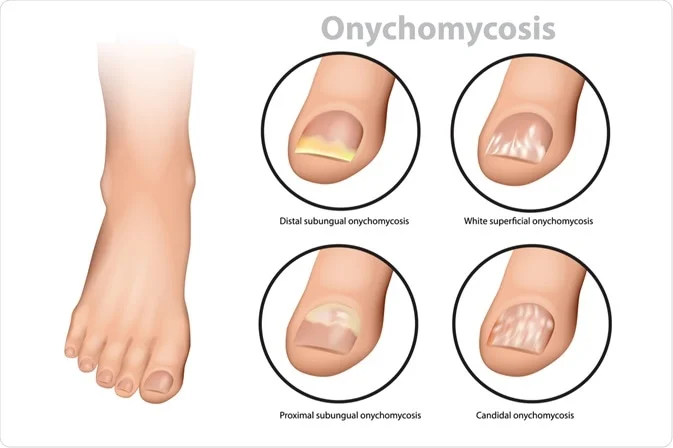 White marks on nails after pedicure: Causes & how to prevent them 3 white marks on nails after pedicure
